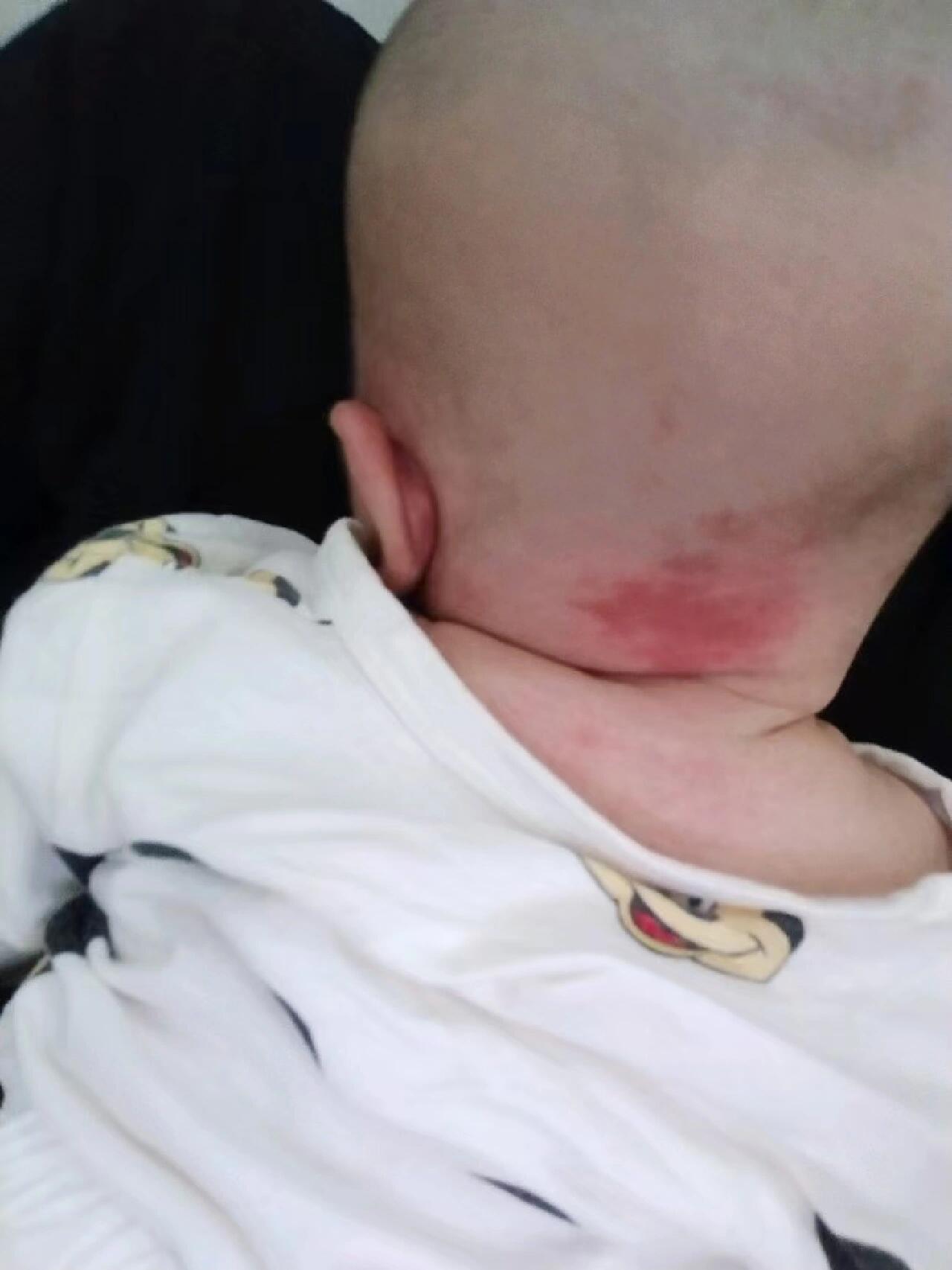 阿里健康首发：婴儿血管瘤外用原研药贝美净®马来酸噻吗洛尔凝胶