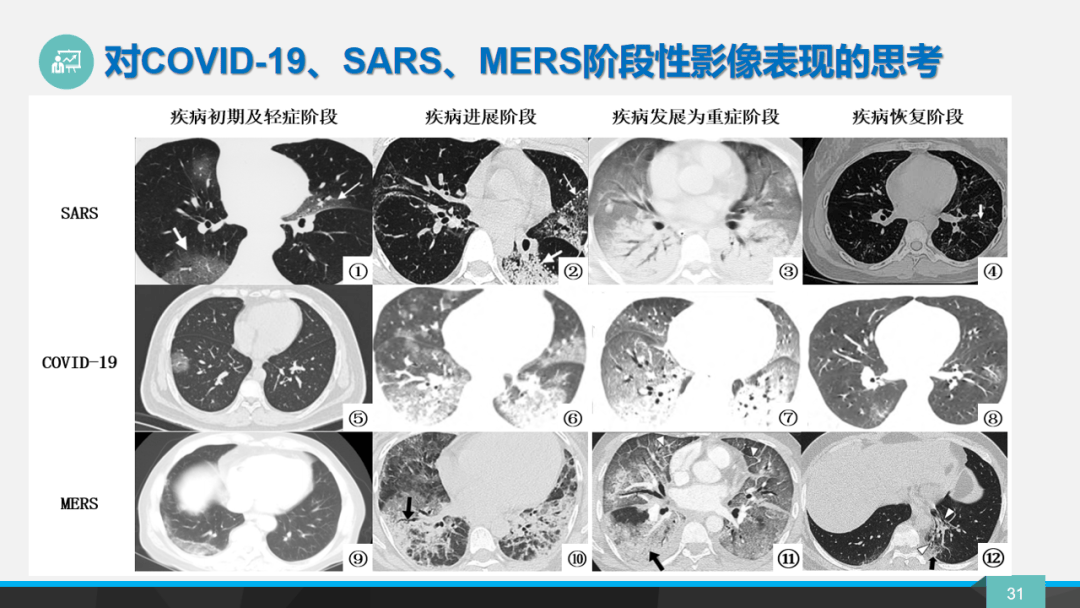 研究发现肺炎易感基因区域